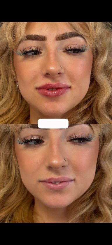 1.1ml Lip Filler